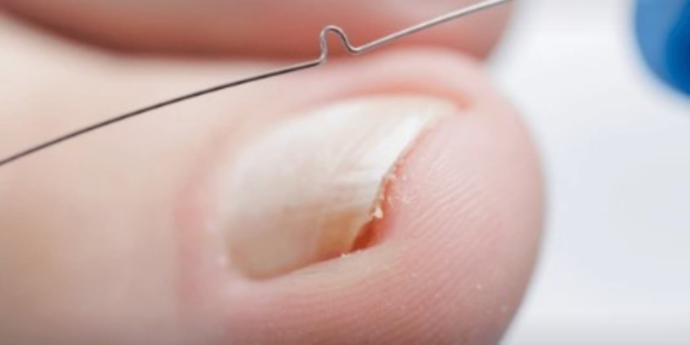 Le traitement des ongles incarnés