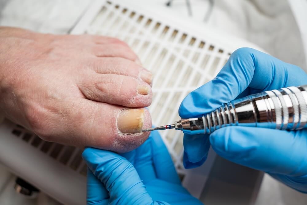 Ongles incarnés : retrouvez le confort au quotidien