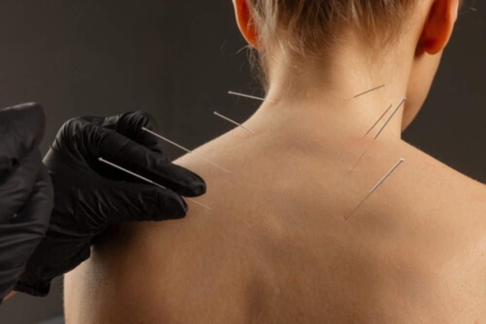 Dry Needling