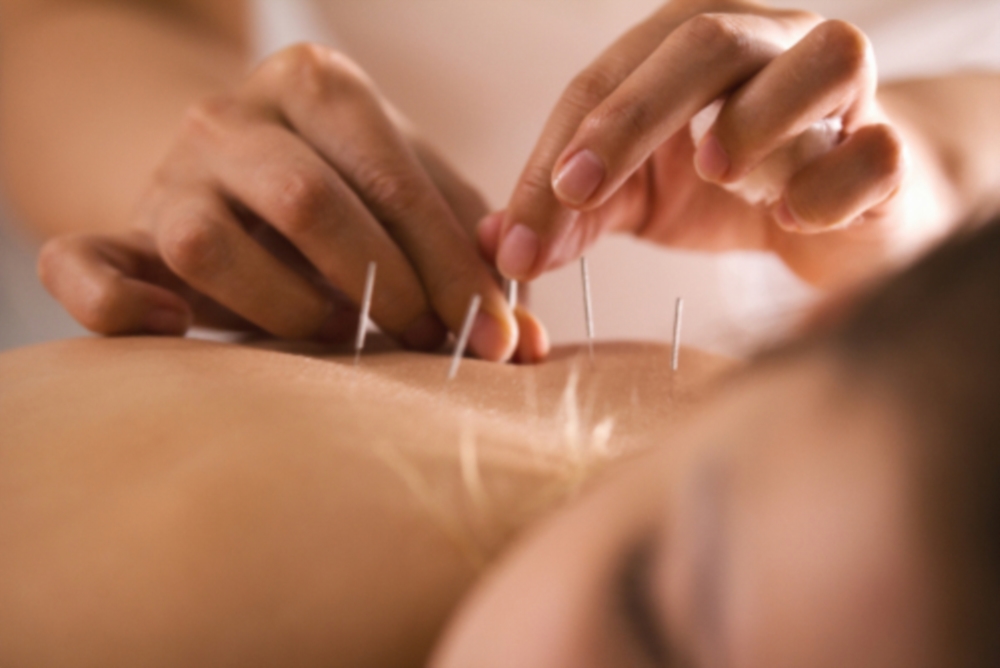 Acupuncture