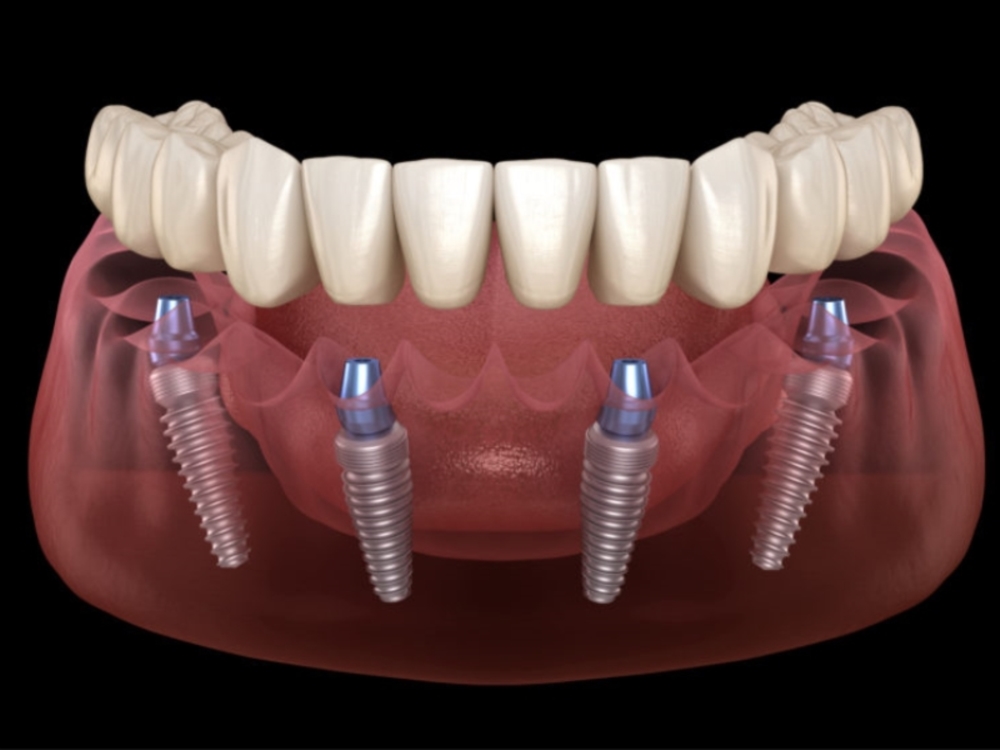 IMPLANTS DENTAIRES