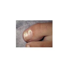 Qu'est-ce qu'une mycose au pied?