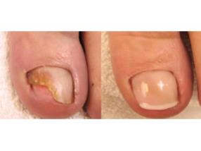 Reconstruction d'ongles