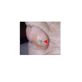 Qu'est-ce qu'un cor au pied ?